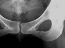 PDF) Les fractures de l'anneau pelvien : aspects épidémiologiques