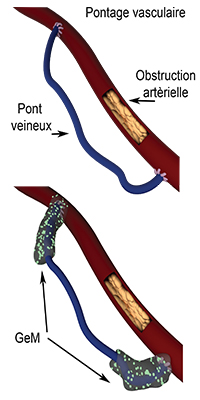 pontage vasculaire