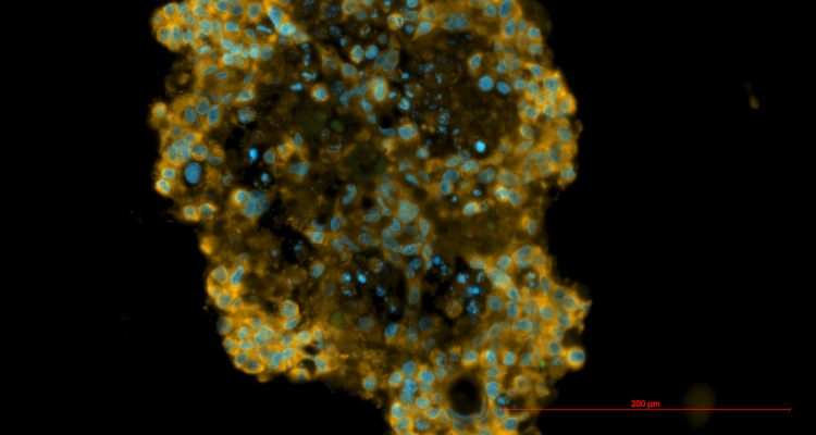 2023.05_Tumor Avatar_Guerrier_Scitech Daily.png