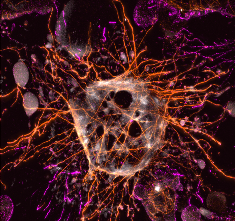 Tumor cell website.png