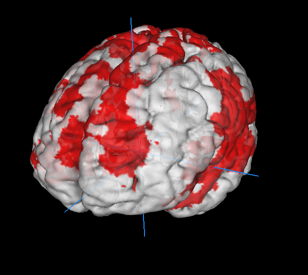 Une mauvaise régulation des émotions peut être visualisée grâce à l’imagerie cérébrale IRM. Sur cette image de cerveau humain, la réponse neurale d’une personne saine après une épreuve de stress psychosocial est visible en rouge.  ©Murray/Piguet
