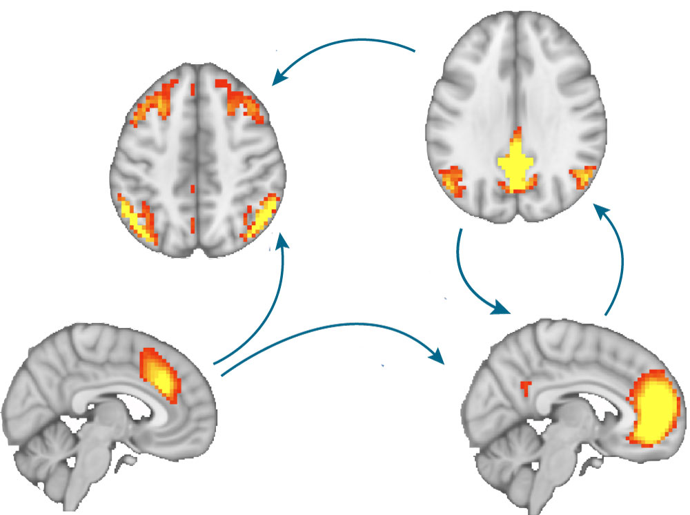 Caption: Different brain states measured by MRI when a patient is at rest. @ EPFL / Zöller
